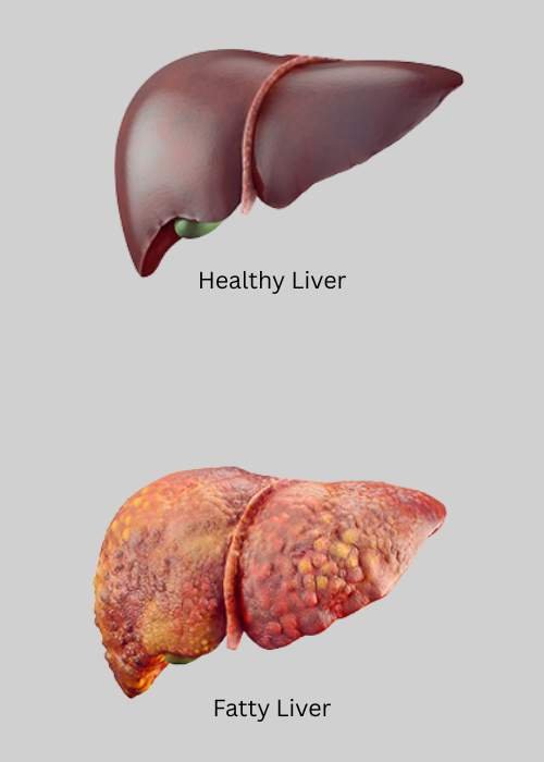 Liver specialistg in Gurgaon