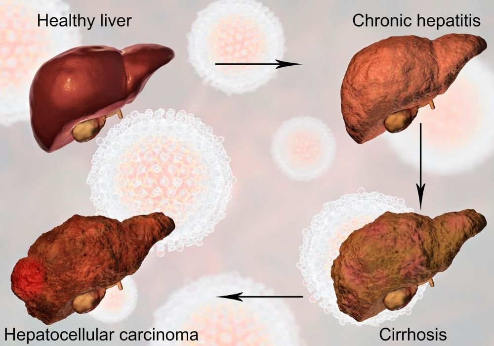 Liver treatment in Gurgaon