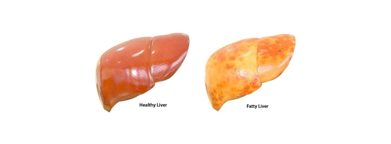 Fatty liver treatment in Gurgaon gurgaon