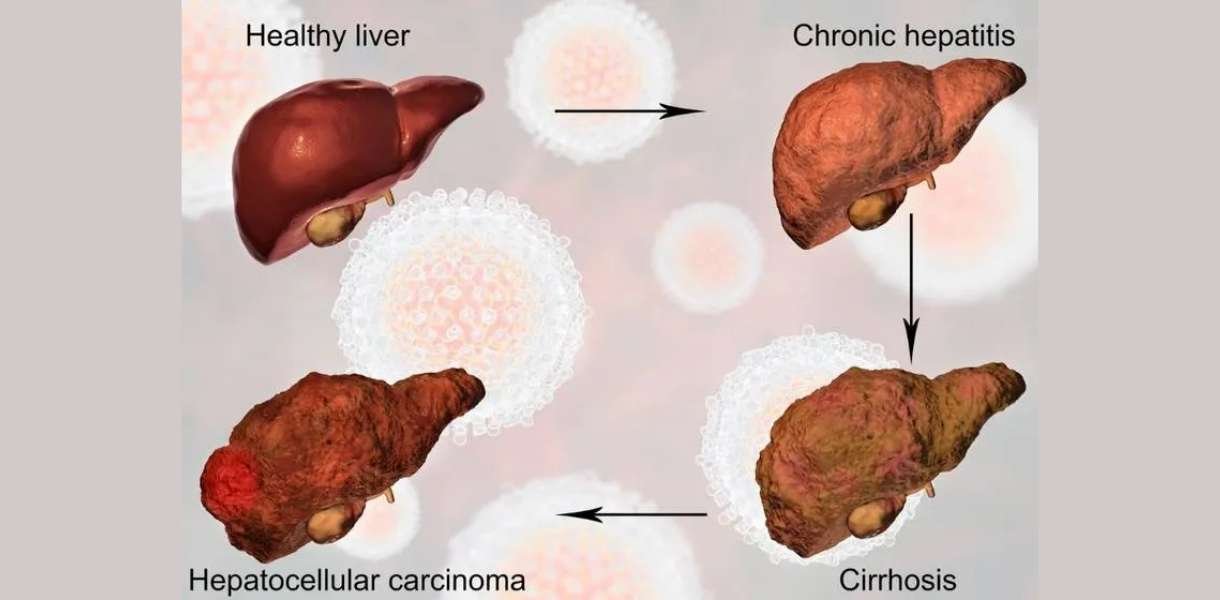liver treatment in gurgaon