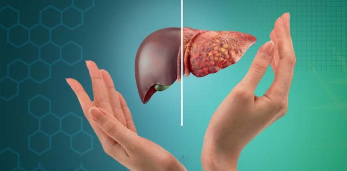 fatty liver treatment gurgaon