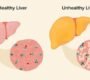 nonalcoholic fatty liver disease 90x80