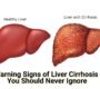 Liver Cirrhosis 90x80