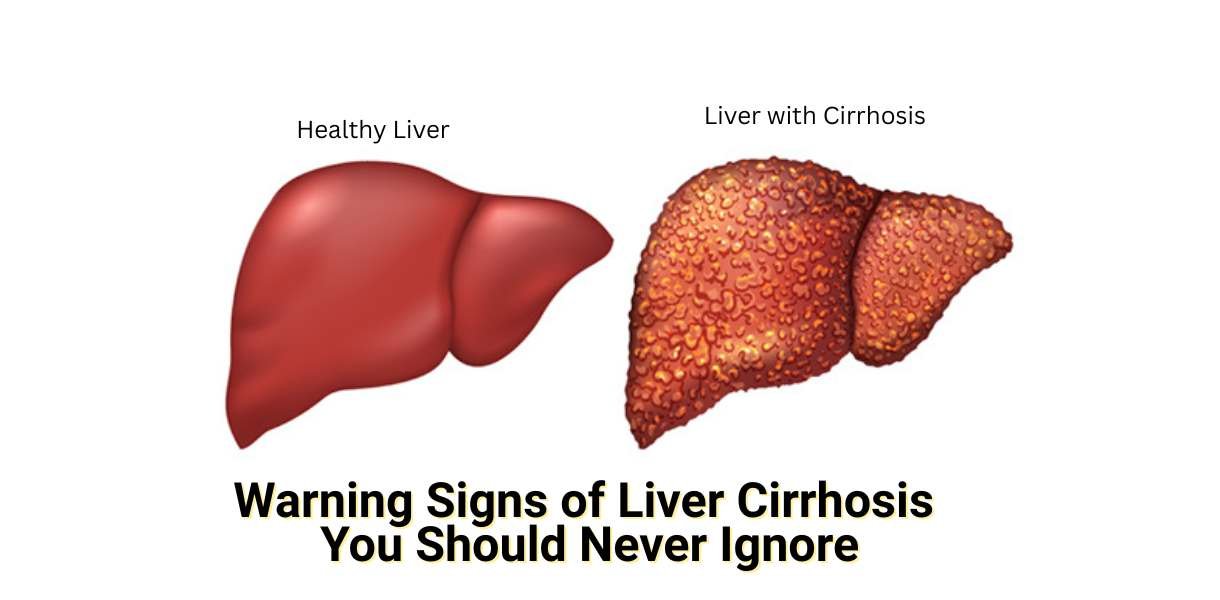Liver Cirrhosis