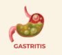 gastritis in gurgaon 90x80