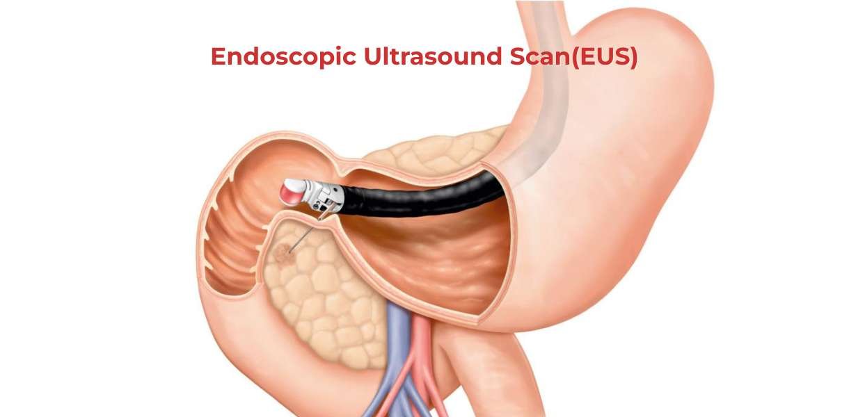 Endoscopic Ultrasound Scan