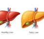 fatty liver gurgaon 90x80