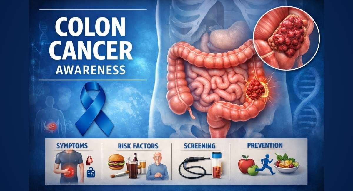 colon cancer
