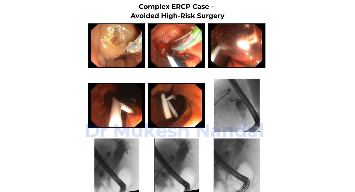 complex ercp case Gurgaon