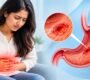 Ulcer Treatment 90x80