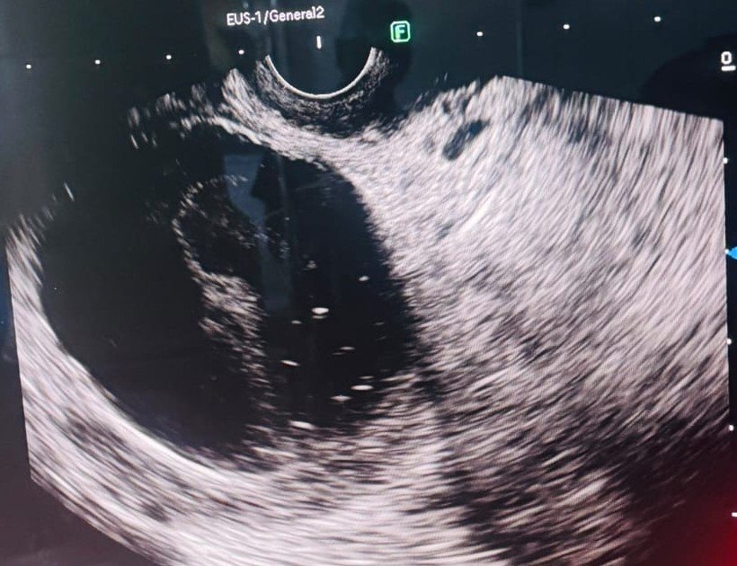 Endoscopic ultrasound image showing a distended gallbladder with internal sludge before EUS-guided gallbladder drainage